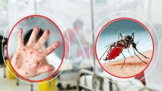 হাম উপসর্গে পাঁচ ও ডেঙ্গুতে দুই জনের মৃত্যু