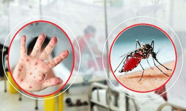 হাম উপসর্গে পাঁচ ও ডেঙ্গুতে দুই জনের মৃত্যু